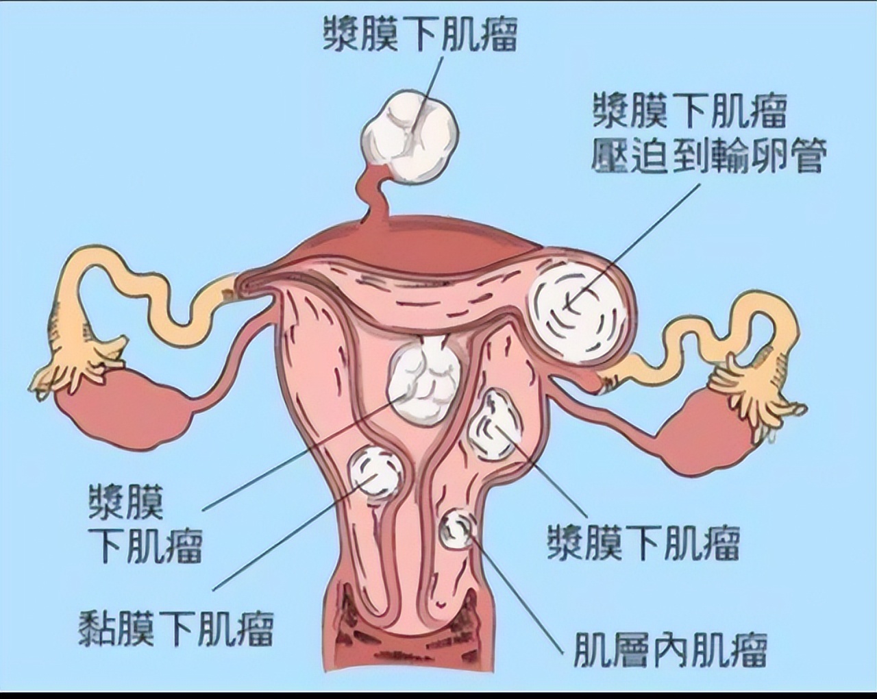 女性为何容易得子宫肌瘤,女性什么原因容易有子宫肌瘤
