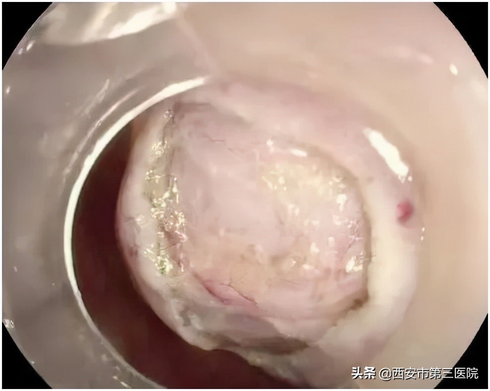 微创时代|内镜下微创直肠肿瘤切除，为您保“肛”