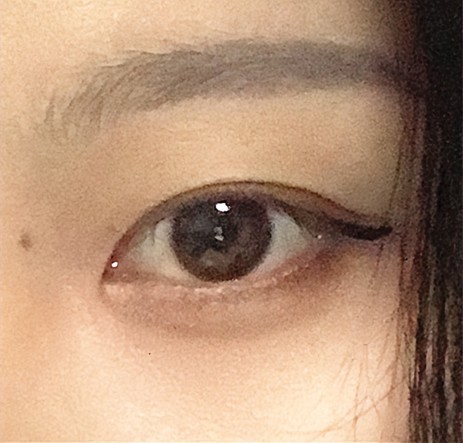 双眼皮贴导致眼皮破了,双眼皮贴导致眼皮严重下垂恢复