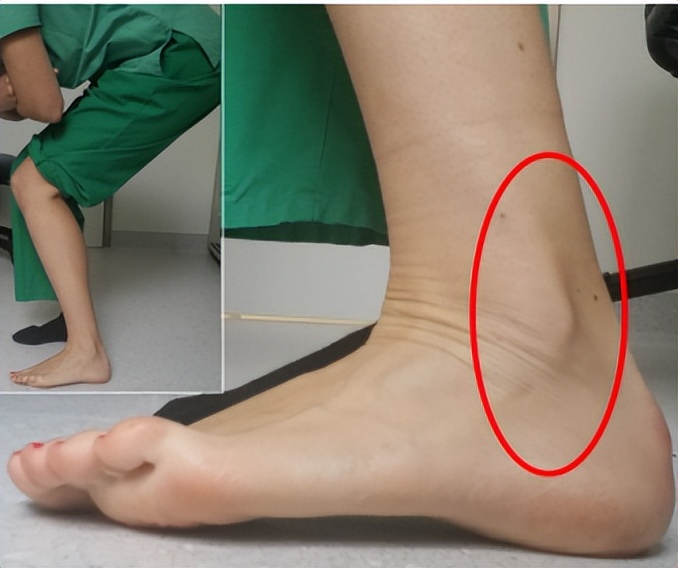 脚踝扭伤腓骨肌腱脱位的症状,踝关节外侧韧带损伤发病原因