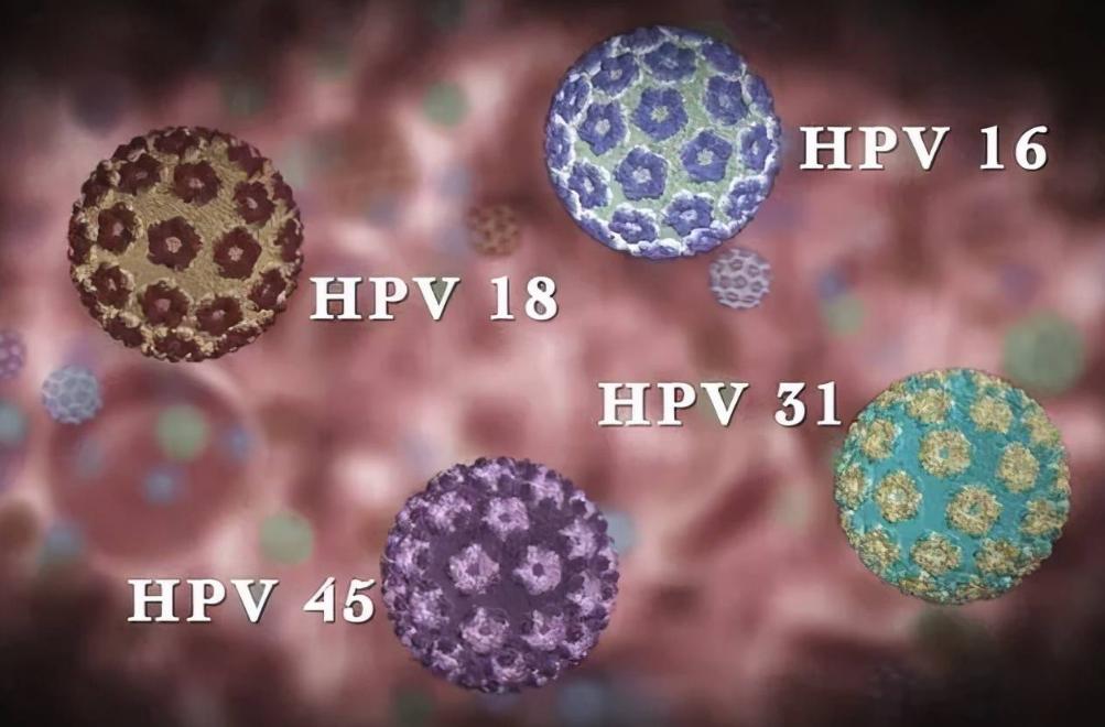45岁女子确诊宫颈癌,子宫全切,提醒:月经若有这种感觉,别大意