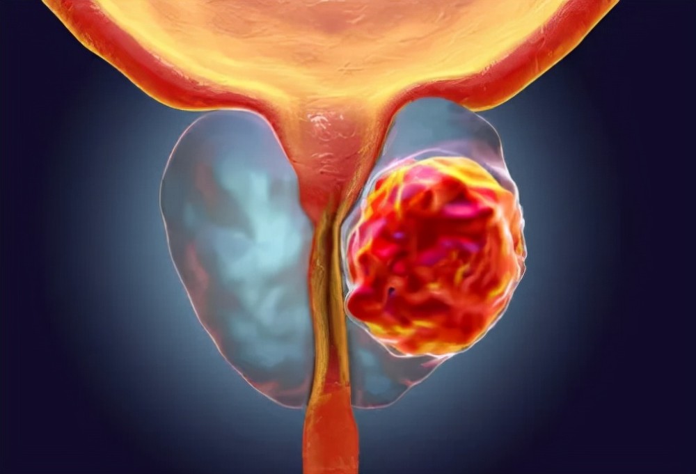 早中期前列腺癌的治疗方案