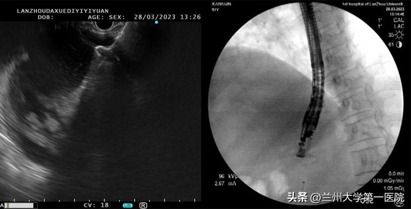 兰大一院成功应用“HOTAXIOS”系统开展超声内镜引导下胰周包裹性积液穿刺置管引流术