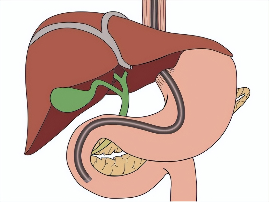 全身炎症反应会导致多器官功能障碍综合征，中西医如何治疗？