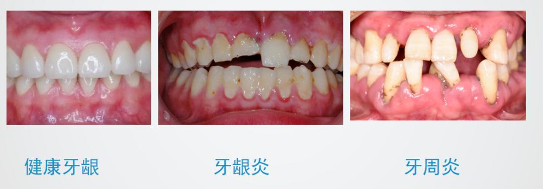 有牙周病可以做牙齿矫正吗,有牙周炎适合做牙齿矫正吗