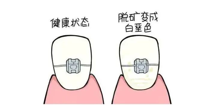 什么是牙齿脱矿怎么预防,牙齿脱矿最佳补救方法