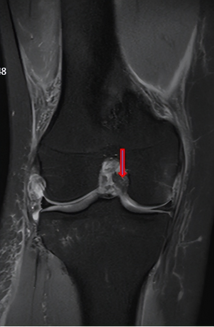 韧带断裂微创手术能恢复正常吗,打篮球韧带断裂做手术多少钱