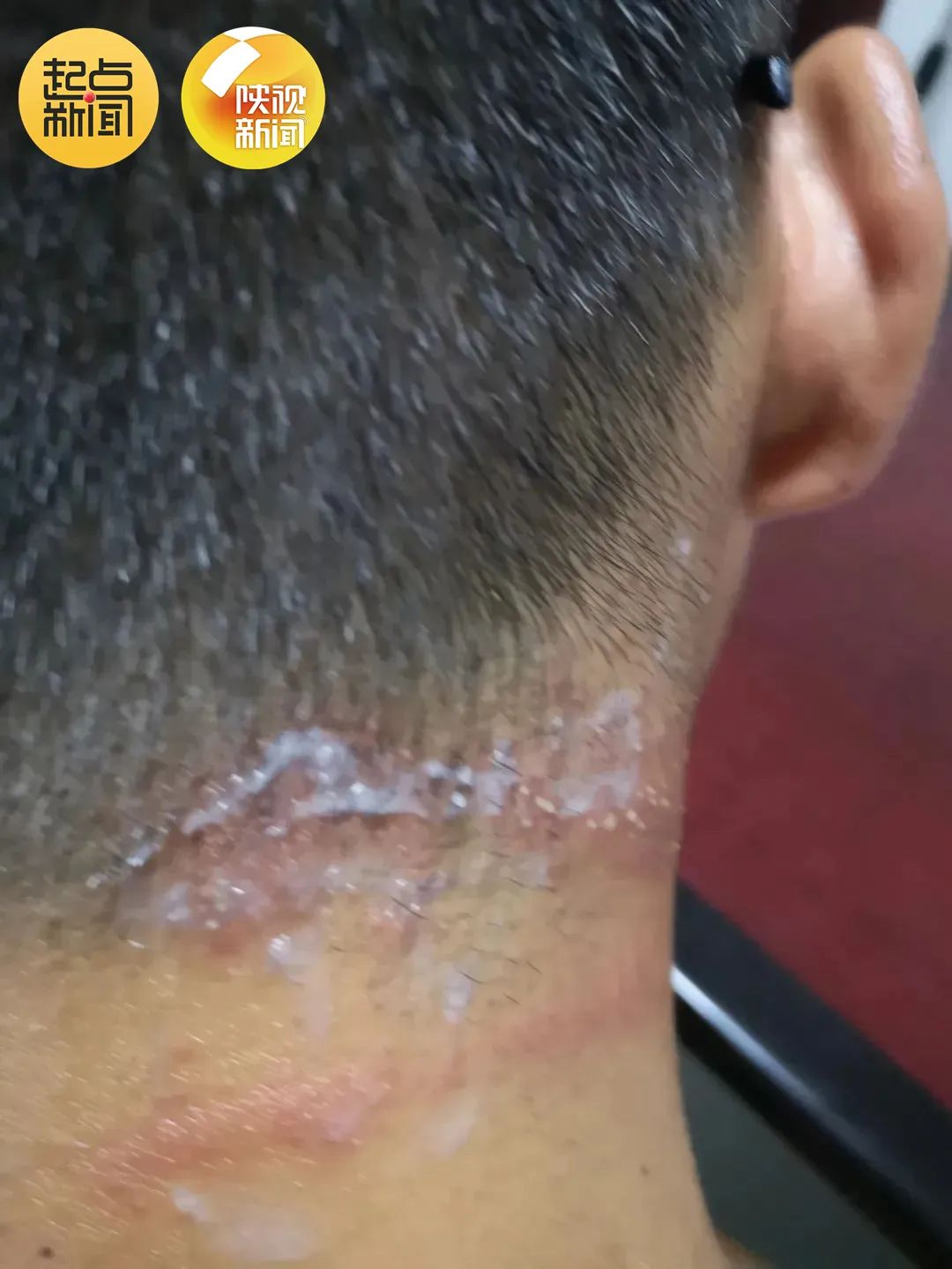 “我的脸被它毁容了…”毒液堪比硫酸！西安也有！