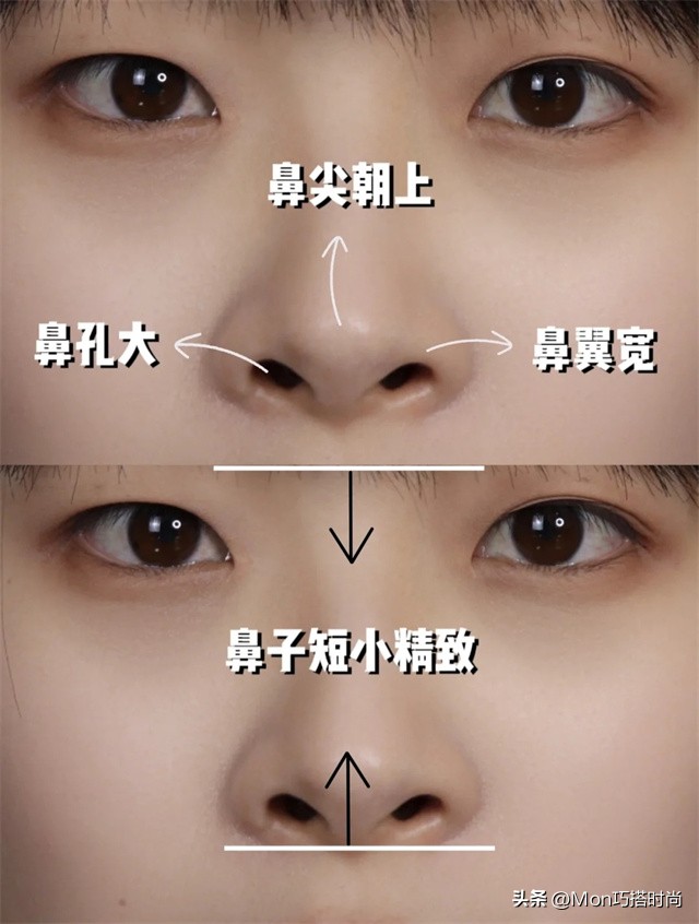 鼻子显凶显老怎么办,鼻子塌陷是不是显得人难看