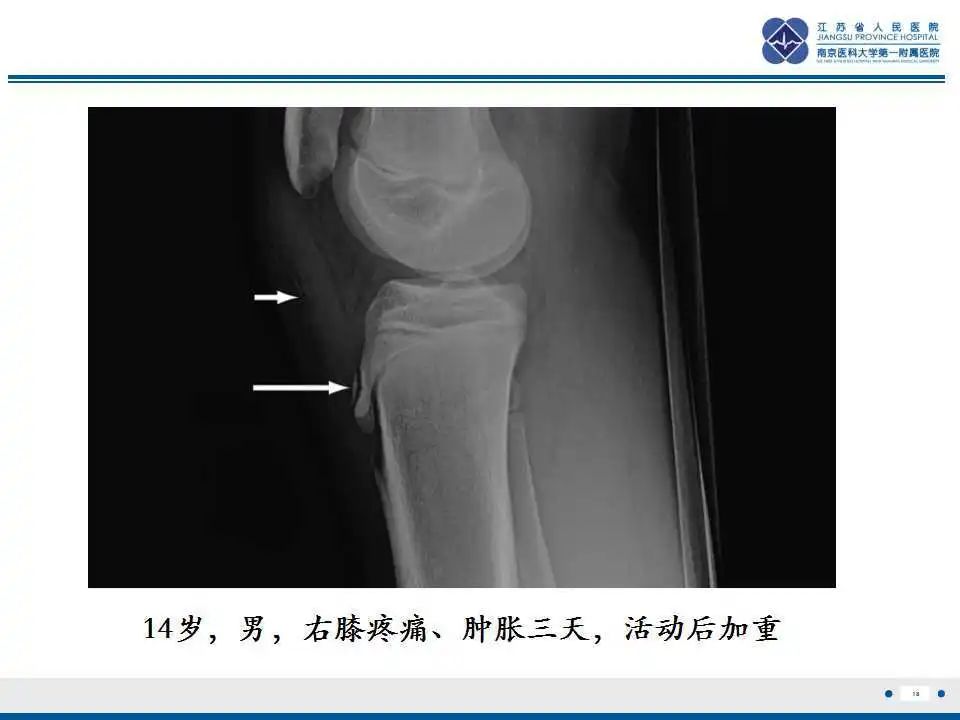 胫骨结节软骨炎要怎么治疗,胫骨结节骨软骨炎会癌变吗