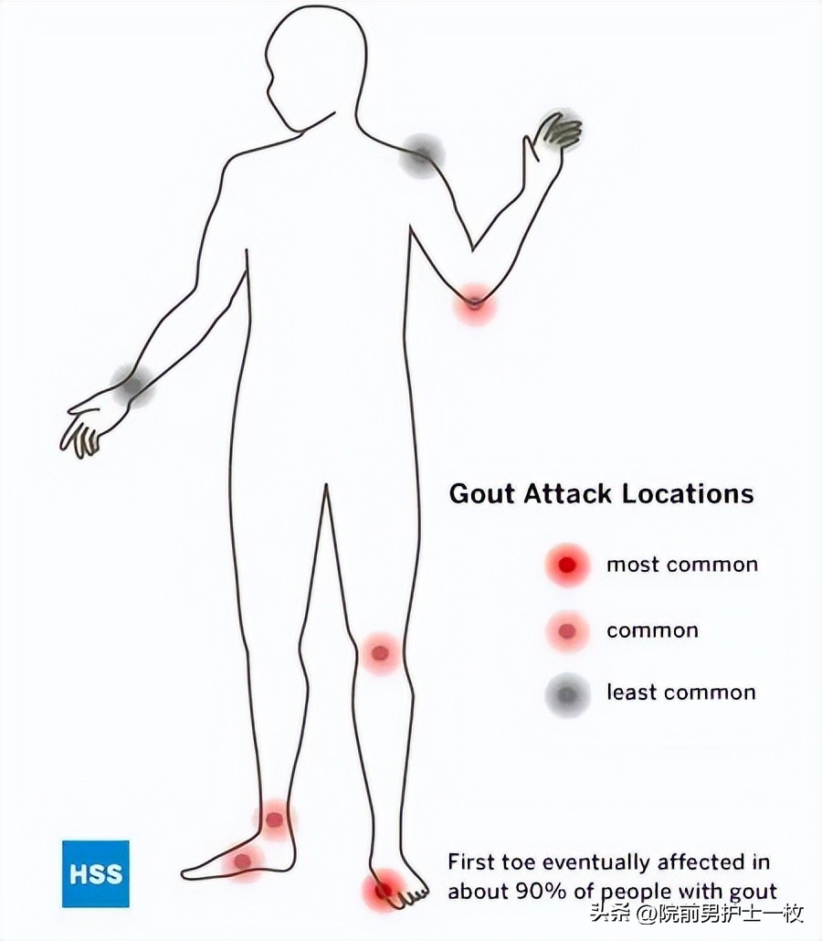 痛风诊治中需要注意哪些问题,痛风的治疗与饮食
