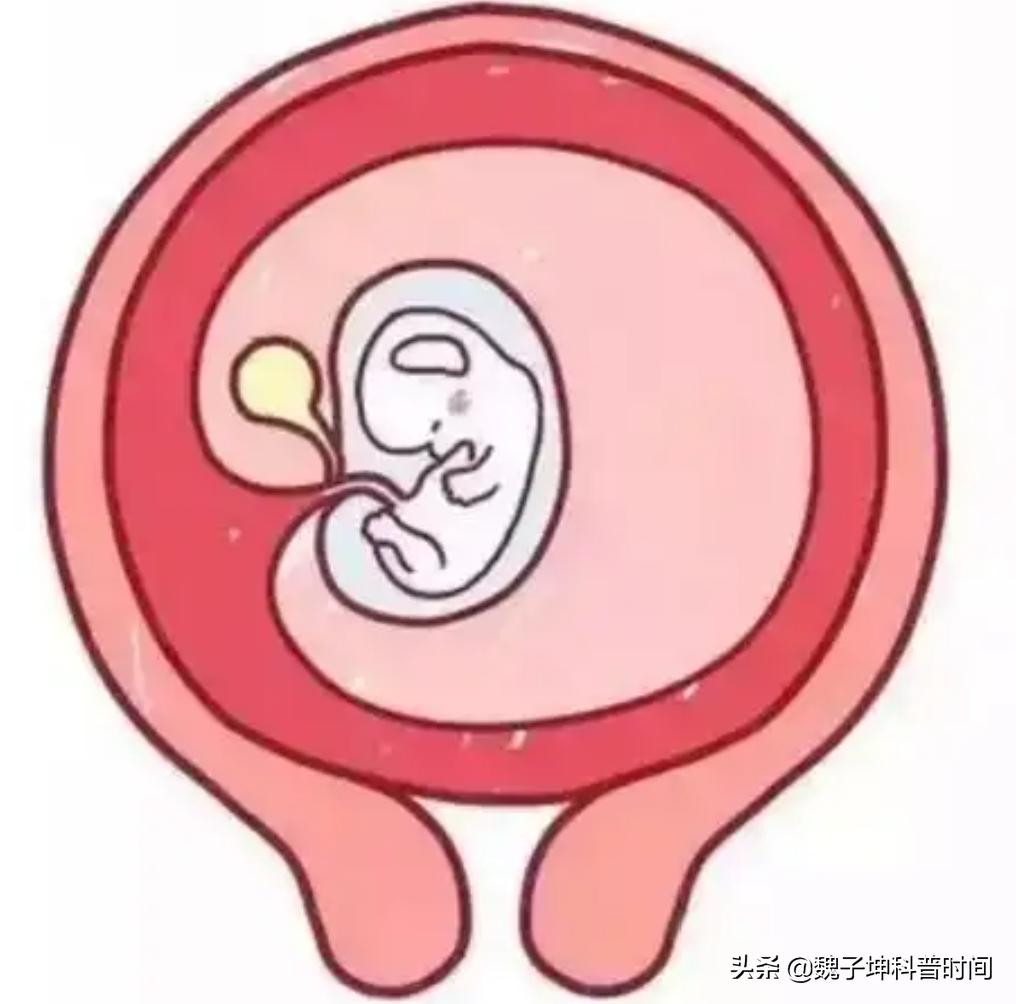 孕囊旁有4mm液性暗区严重吗,孕囊旁可见液性暗区什么意思