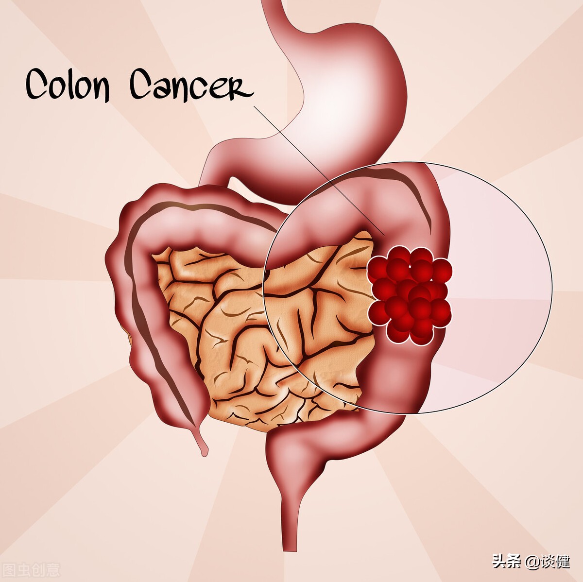 大肠癌的最佳防治方法,大肠癌手术难度大吗