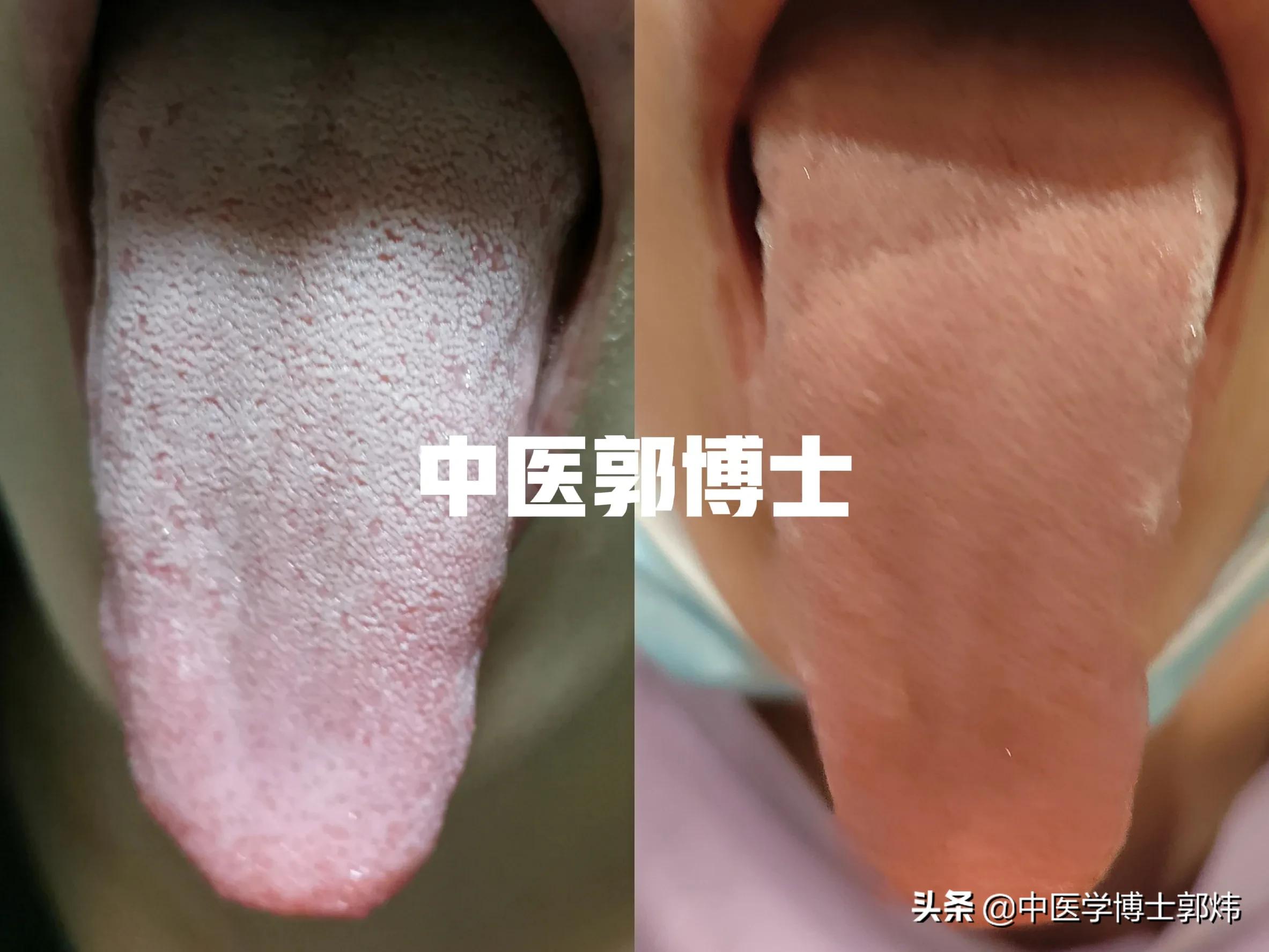 hpv阳性宫颈病变物理治疗几次,宫颈糜烂导致hpv感染要注意什么