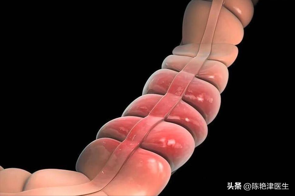 大肠癌治疗后肠息肉反复生长,息肉已经切除怎么还得大肠癌