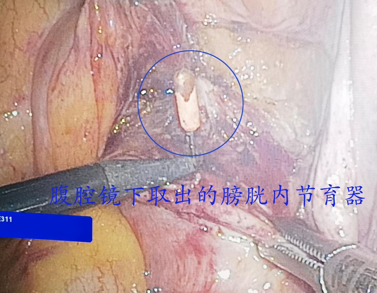 哈医大一院子宫附件切除手术,哈医大一院群力妇科