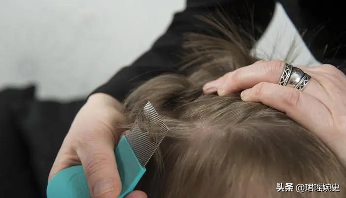 80年代头上为什么会有虱子,30年前都有虱子