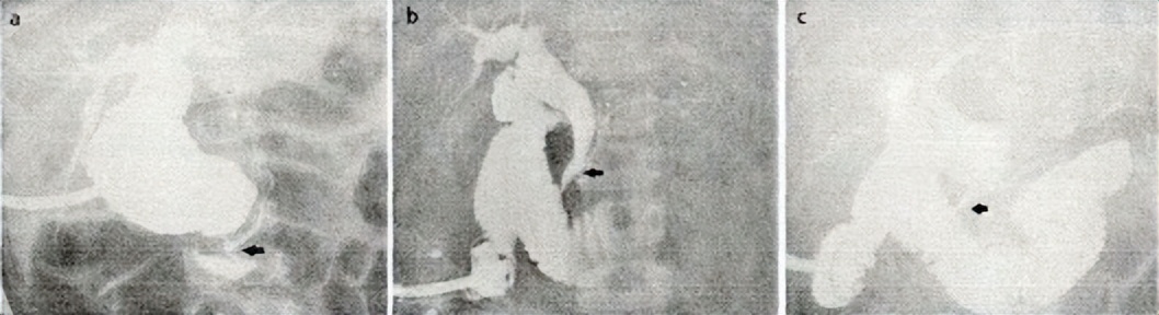 胰胆管合流异常影像诊断,基于影像组学的深度学习