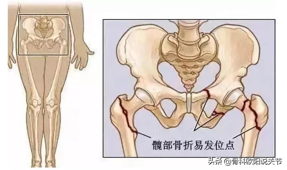 髋部骨折为什么难恢复,为什么髋部是人生最后一次骨折