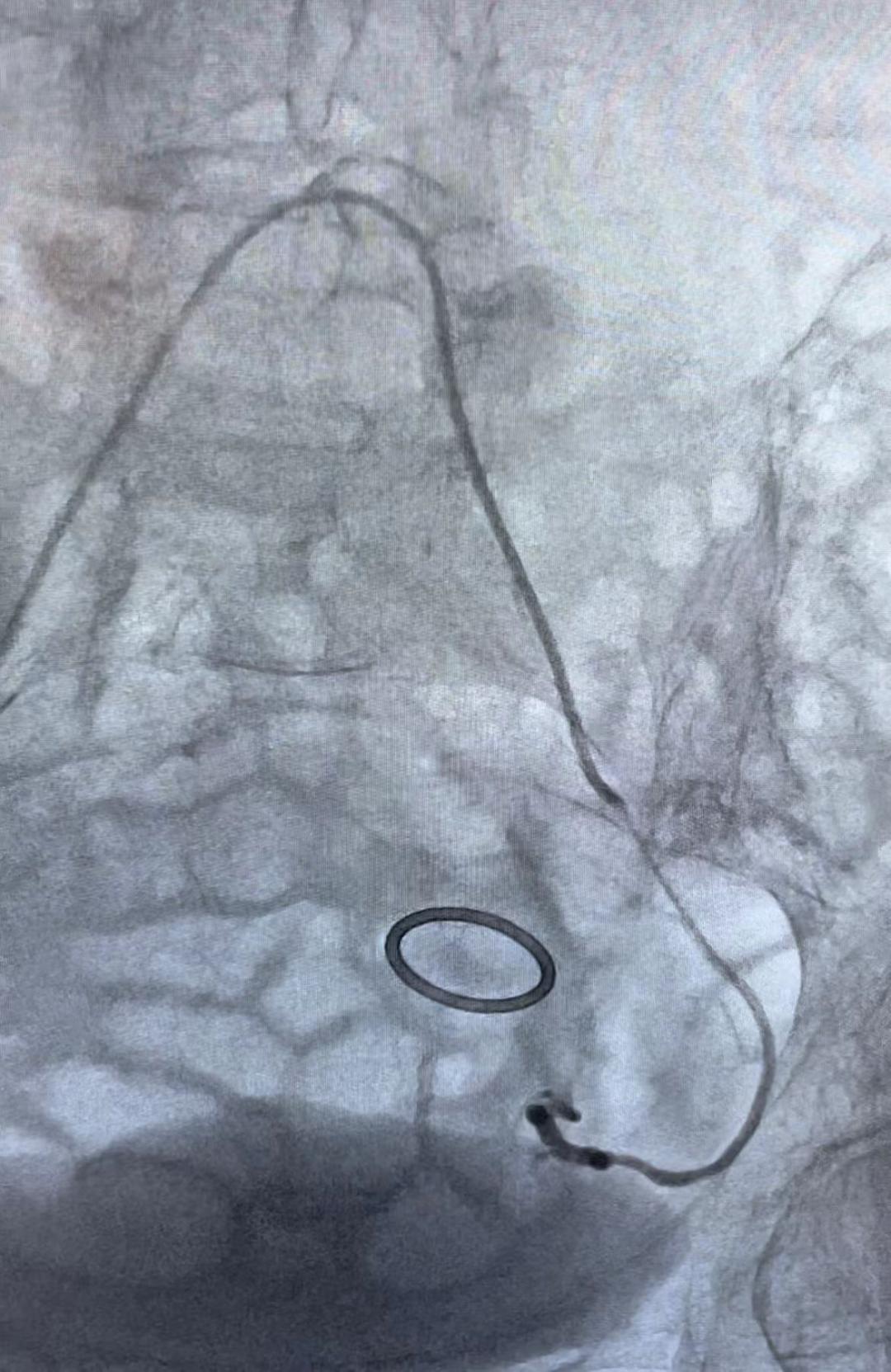 mdt治肿瘤效果怎么样,宫颈癌化疗血小板低拉血不止
