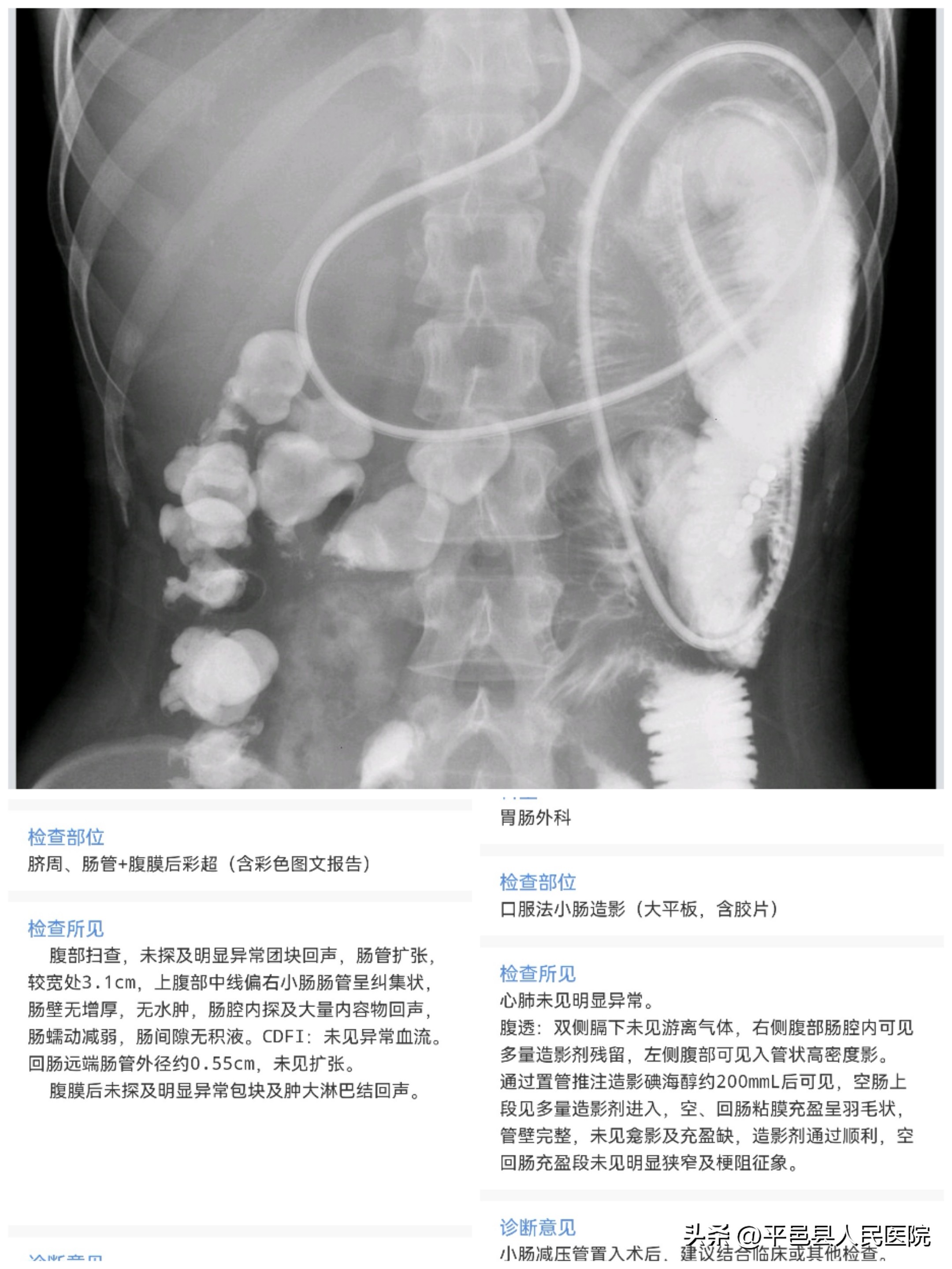 双十年华突发严重多发外伤多科协作联合手术成功救治