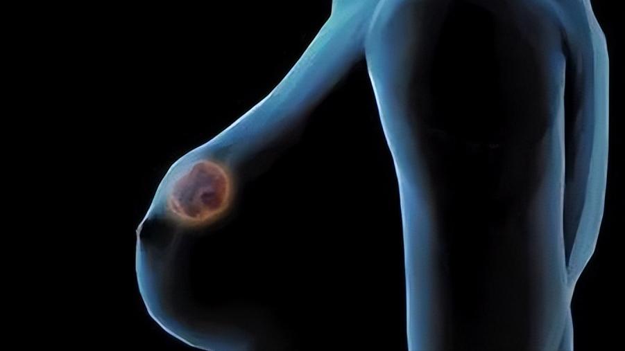 56岁阿姨得乳腺癌,56岁王阿姨现状