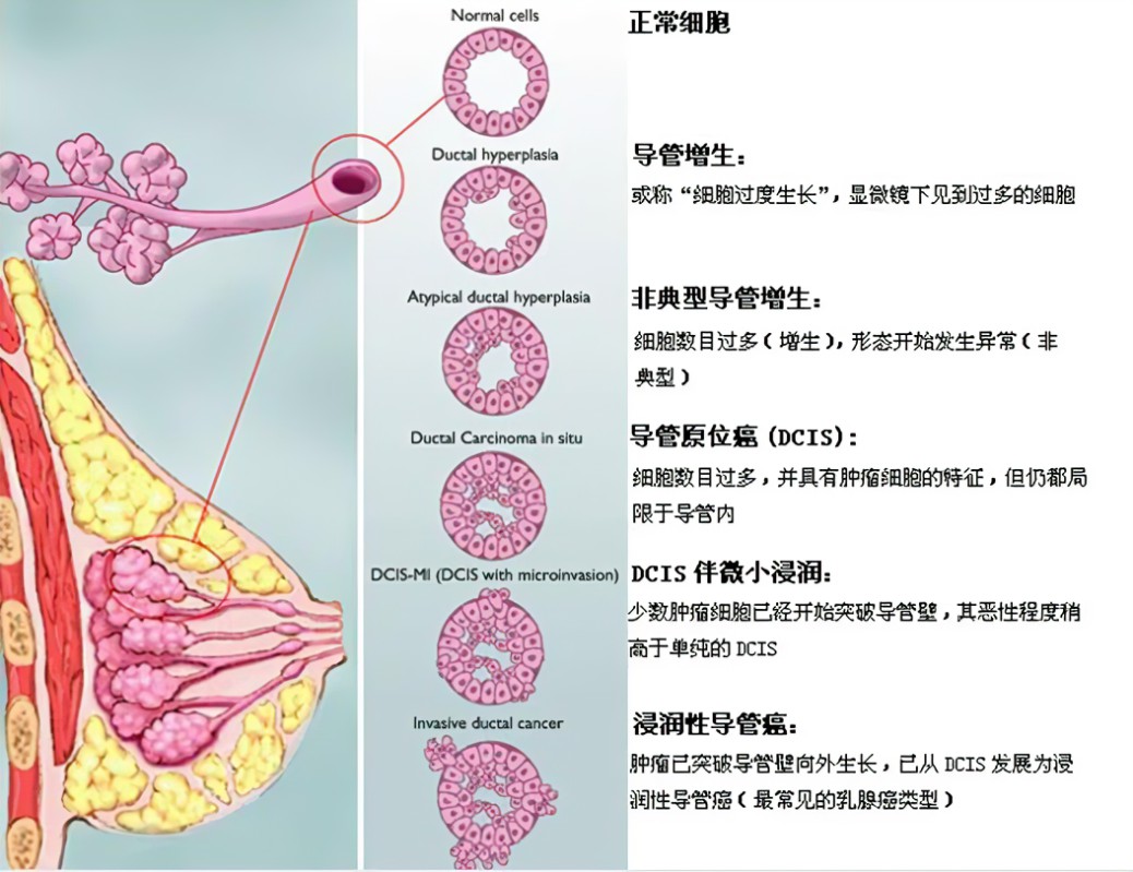 如何看懂乳腺癌病理报告,乳腺癌病理报告怎么看要不要化疗