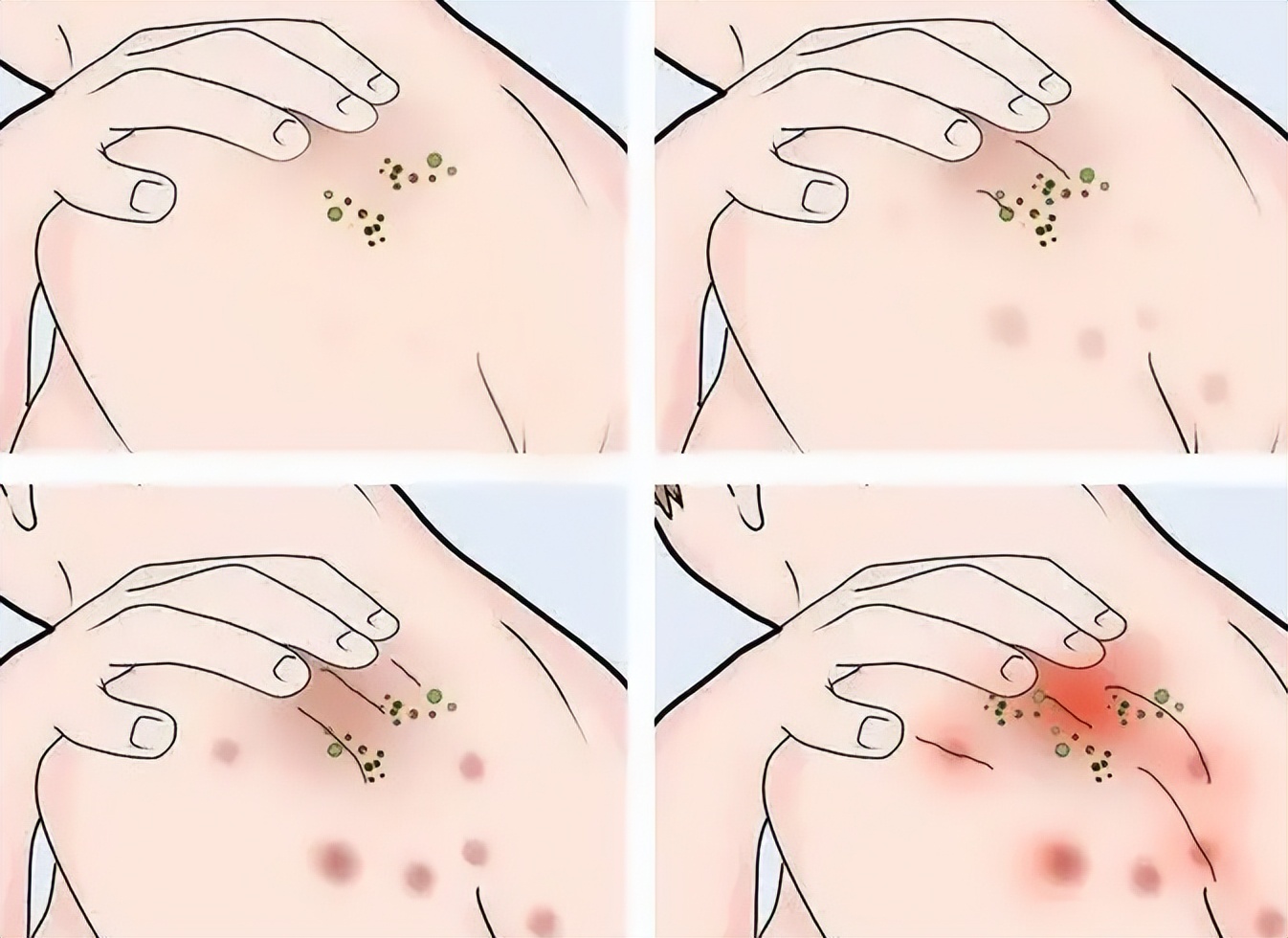 疤痕疙瘩破了出脓怎么治,疤痕疙瘩破溃怎么治疗