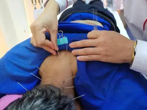 头部脑供血不足穴位,头部穴位针灸的作用