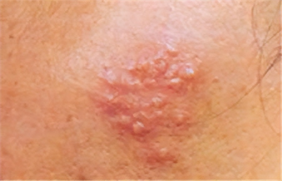 蛇盘疮越长越多怎么办,蛇盘疮腰缠一圈真的会要人命吗