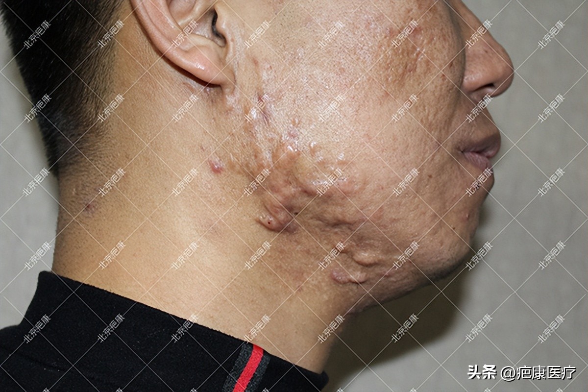 脸颊疤痕疙瘩治疗过程图,疤痕疙瘩脸颊