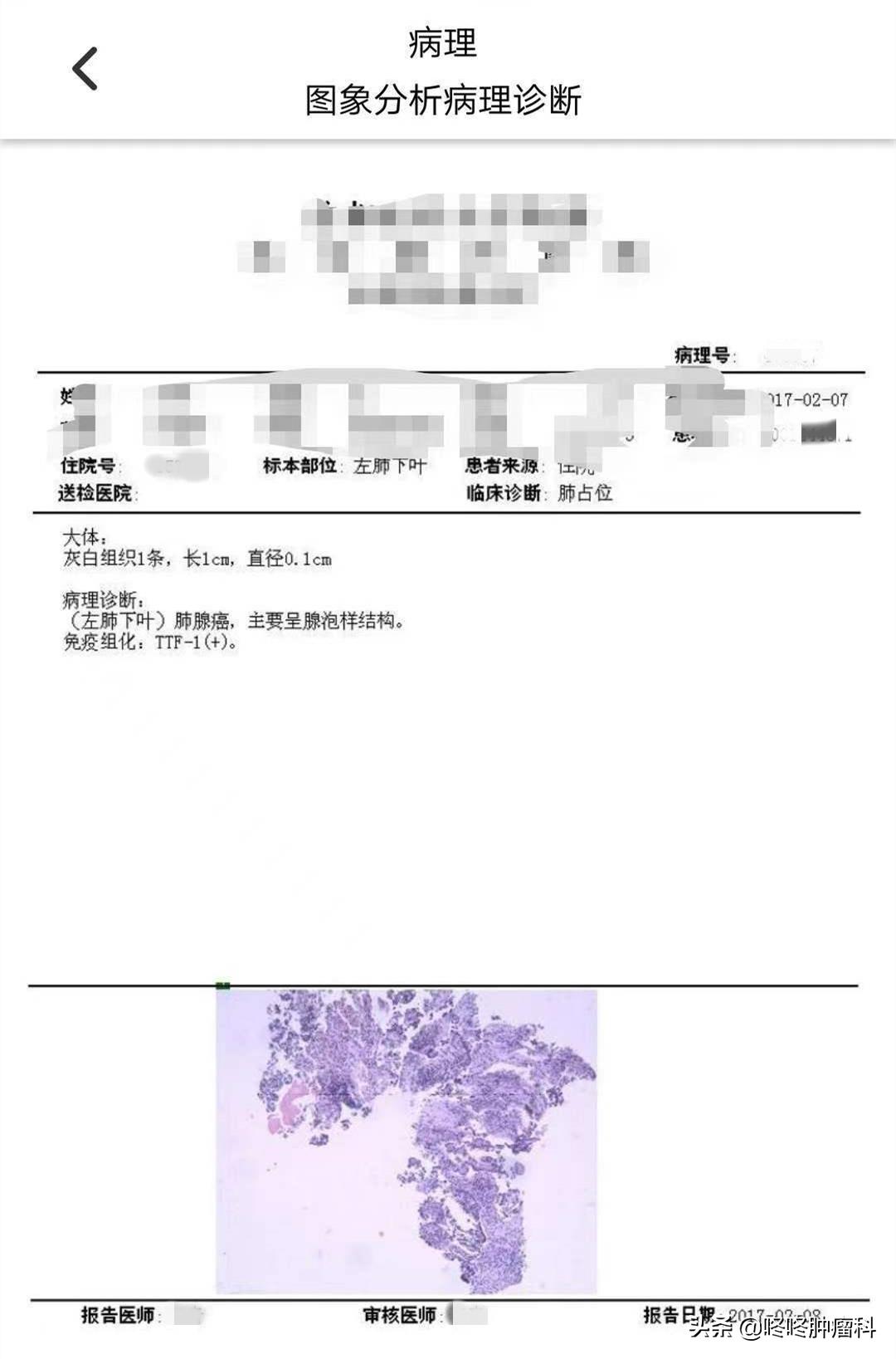 抗癌靶向药化疗,抗癌5年后靶向治疗