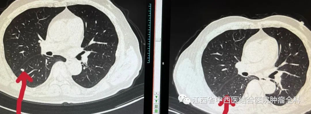 肝癌多发性肝内转移靶向药,肝癌中晚期免疫靶向有奇迹出现吗