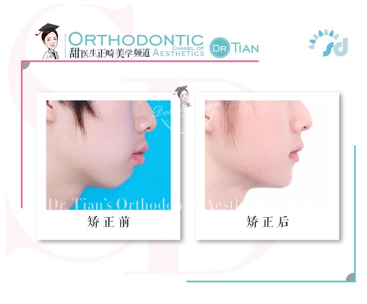 不拔牙矫正嘴凸下巴后缩案例,嘴瘪不拔牙矫正嘴会凸怎么办