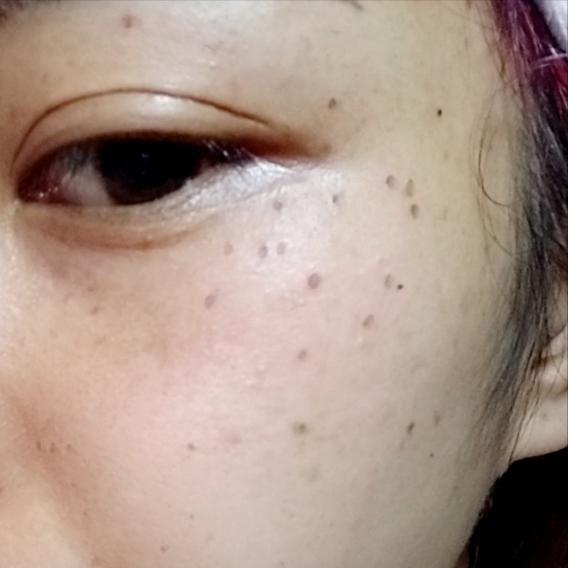 黑色素提取祛斑和激光祛斑哪个好,祛斑要技术吗