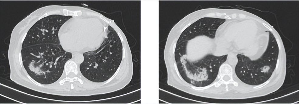 乳腺癌晚期没多少钱怎么治疗最佳,经济困难癌症晚期可以放弃治疗吗