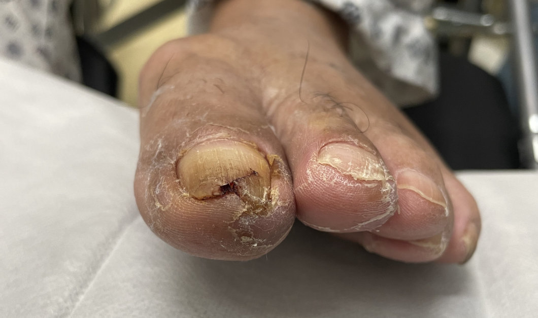 老年人厚指甲修剪过程,老年人脚趾甲厚修剪用什么剪刀