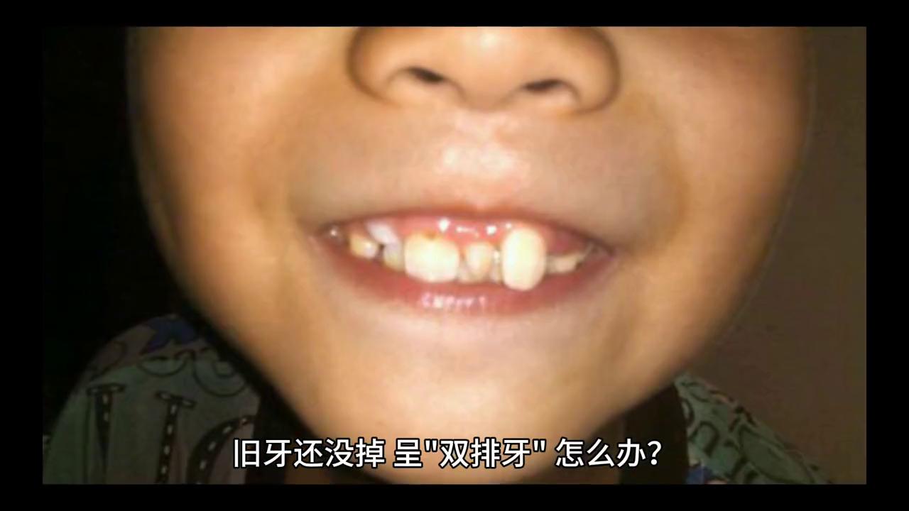 小孩换牙时长出双层牙怎么办,小孩换牙妈妈怎么引导