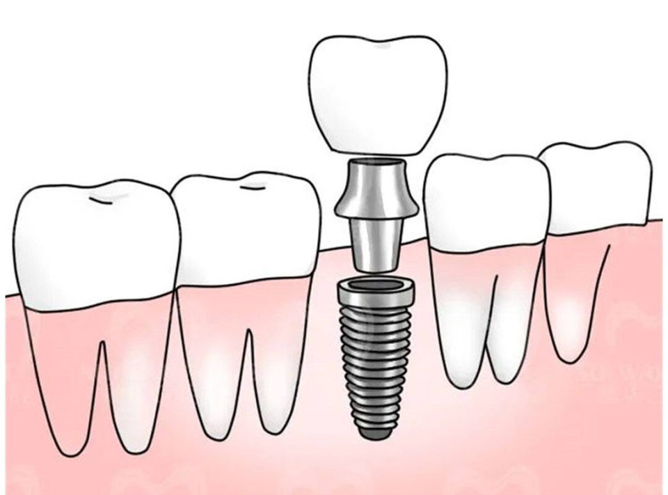 瑞士诺贝尔高端种植牙,诺贝尔金致植体奥齿泰