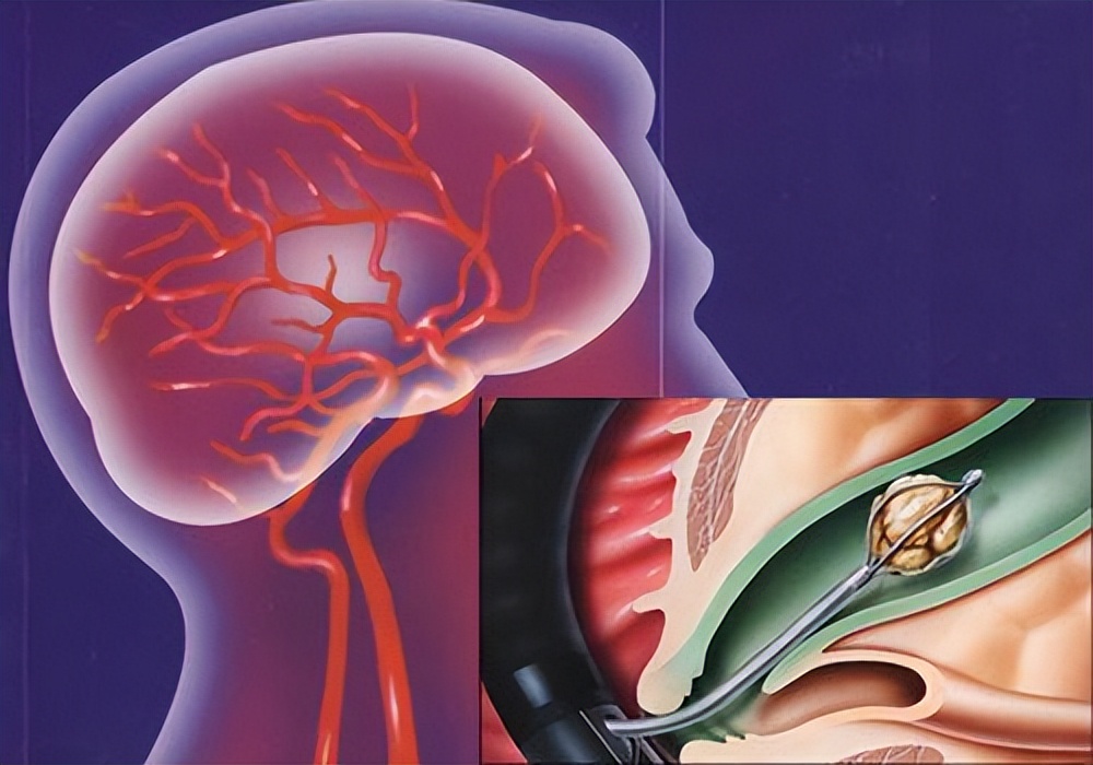 脑血管康复训练动作视频教程全集,脑血管病的康复训练