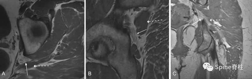 针灸治疗梨状肌综合征,一文了解贲门失弛缓症