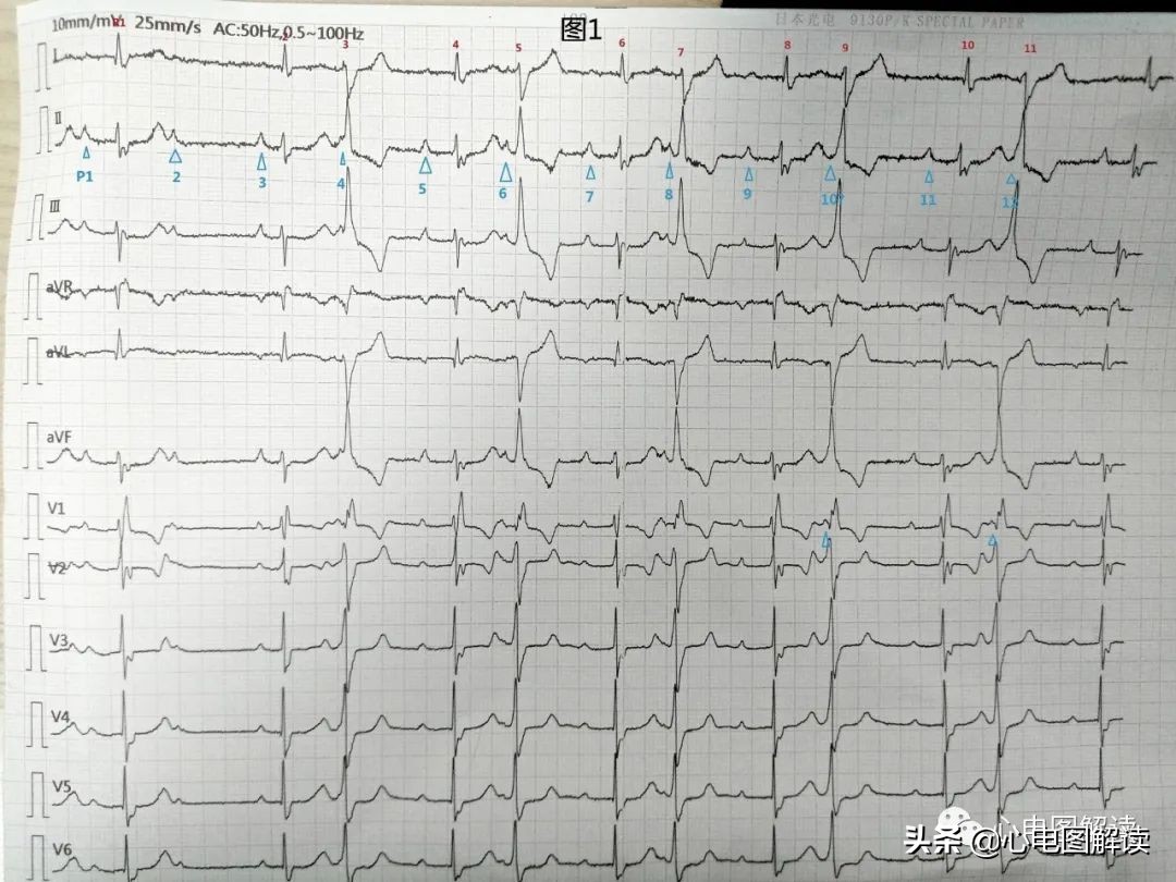 二度房室阻滞、室性早搏、室性逸搏？