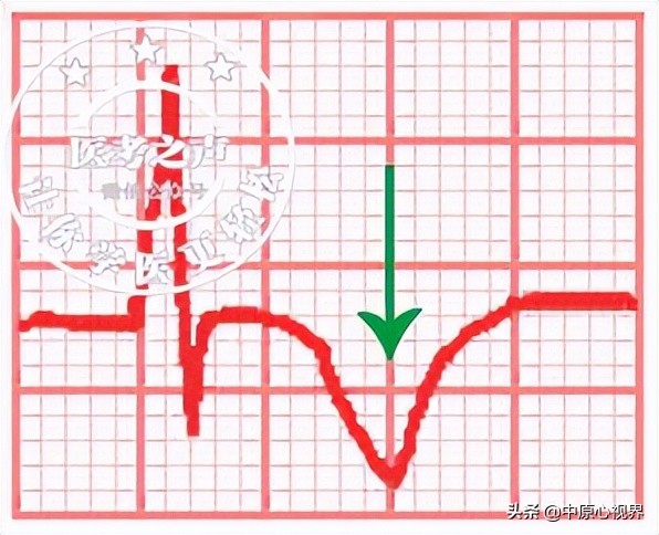 护考几种常见的心电图,常见的心电图图形分析