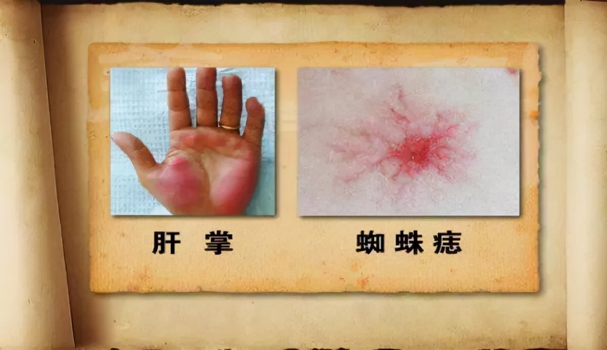 经常放屁多是肝不好帮你揪出原因,经常放屁与肝不好有关吗