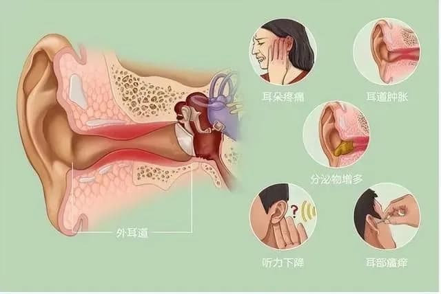 湿疹要怎么预防,婴儿出现头皮湿疹和外耳道湿疹
