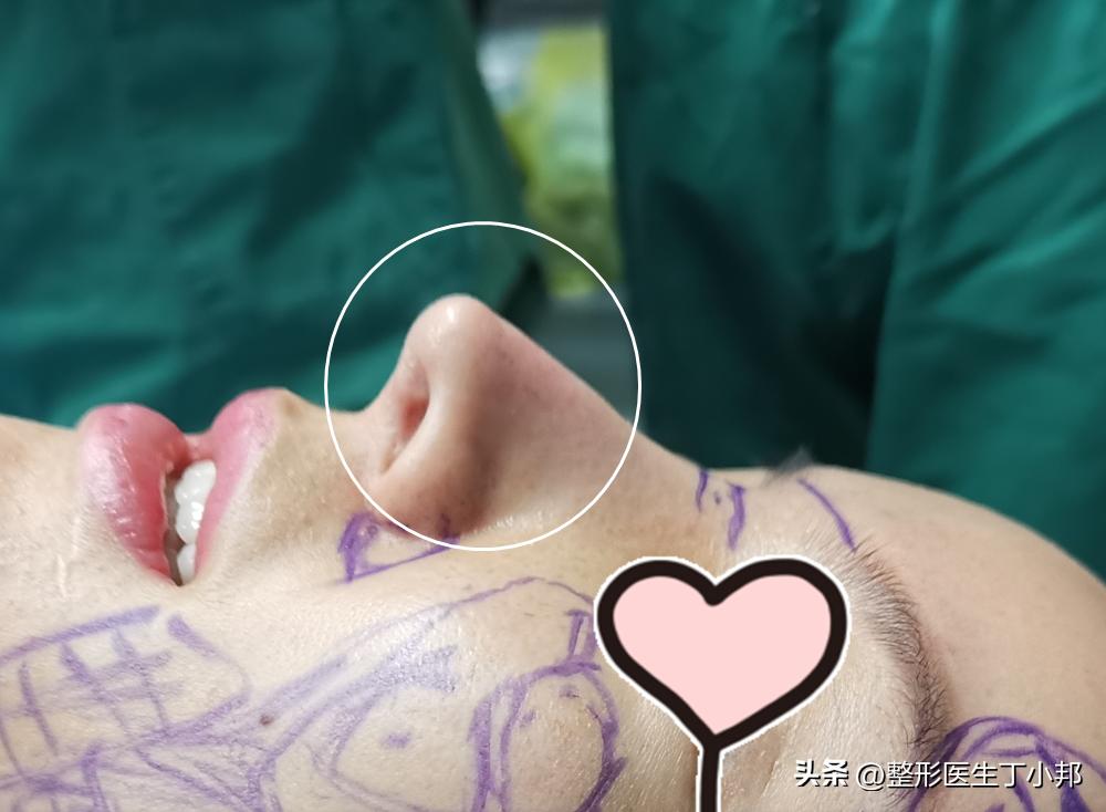 假体隆鼻发红怎么修复,假体隆鼻透光是怎么回事