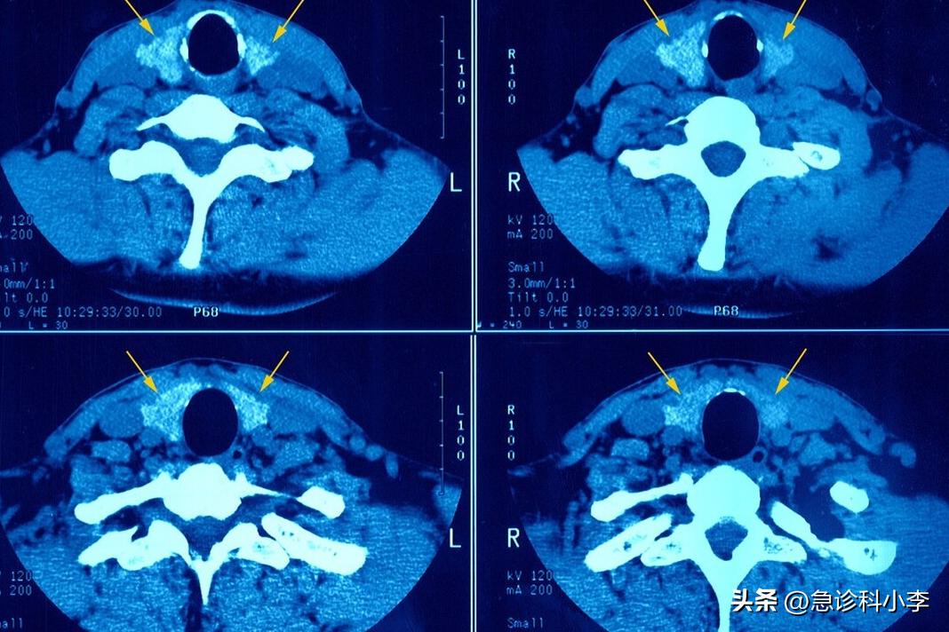 甲状腺实性结节4a癌变几率有多大,长了甲状腺结节癌变的几率有多大