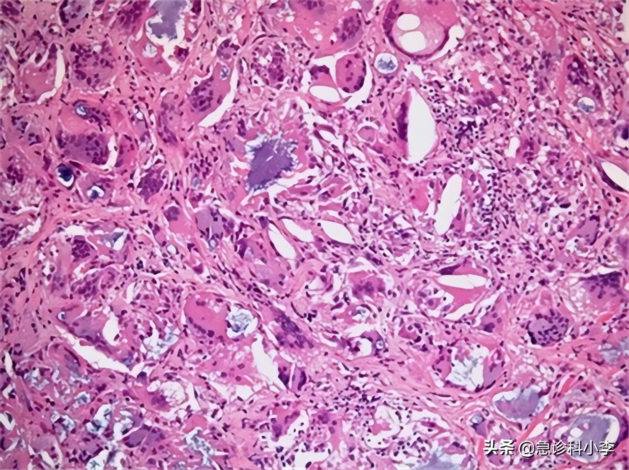 幽门螺杆菌是胃病的罪魁祸首吗,幽门螺杆菌一直治不好怎么办