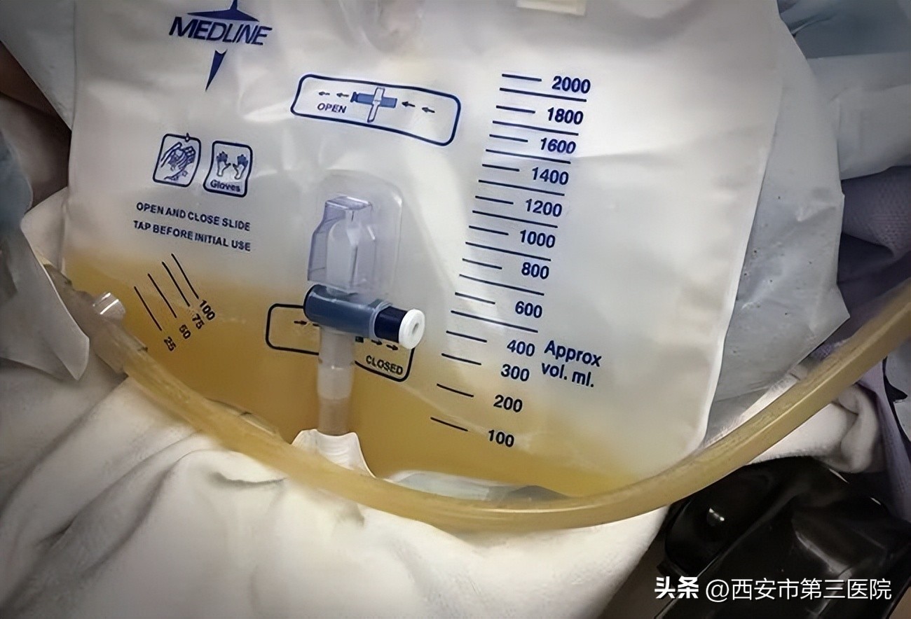 “带管余生”|长期留置导尿的护理