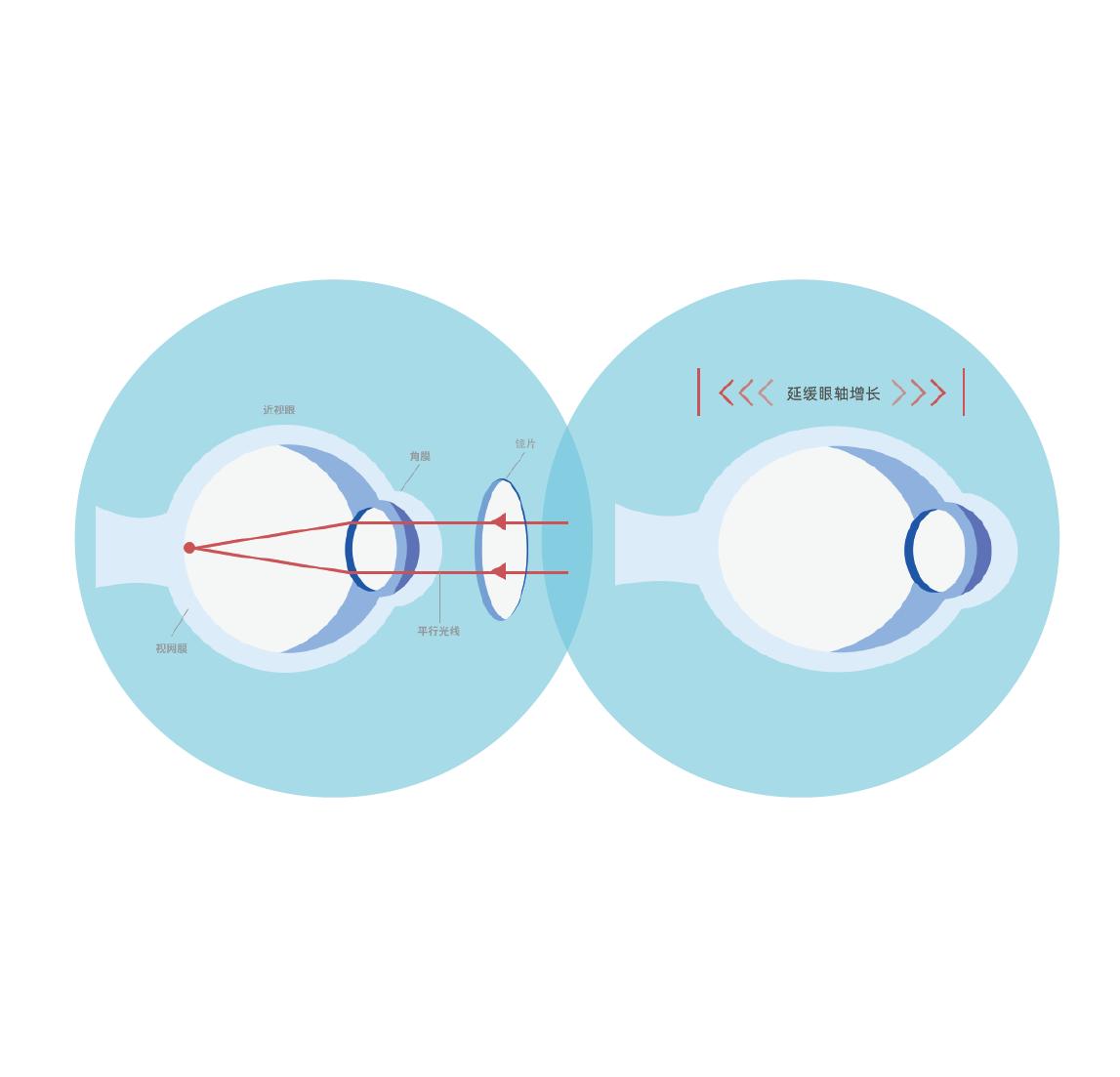 近视矫正镜片,关于近视矫正
